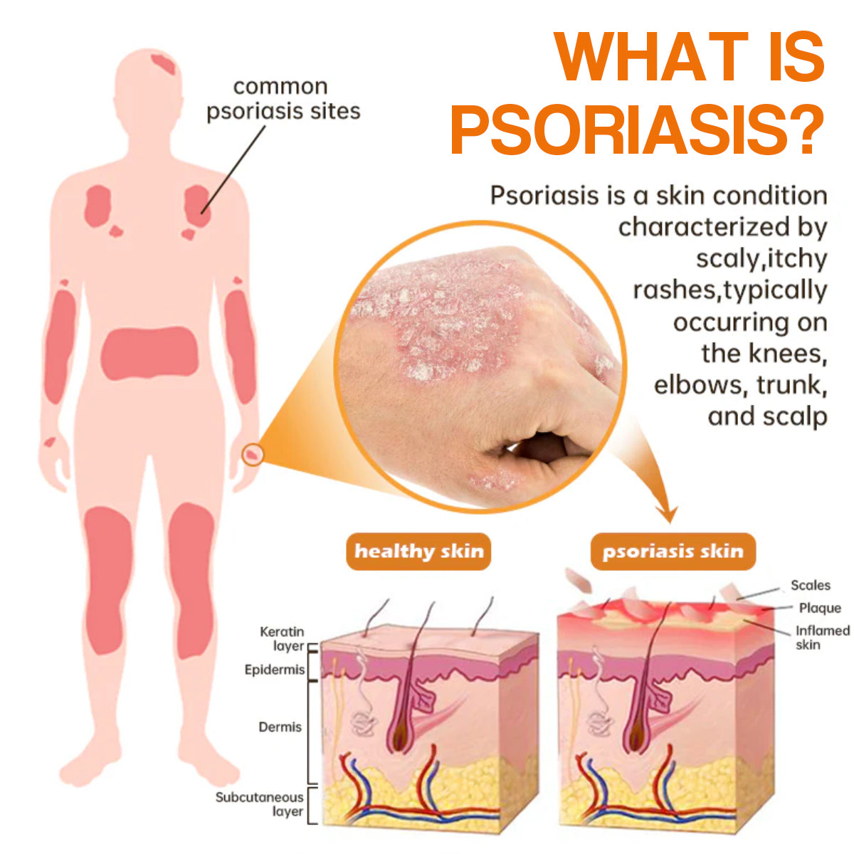 ✨【 official Brand Store】 Last Day Discount: 83% OFF 🌸 Seurico™ PsoriaHeal psoriasis Spray pro
