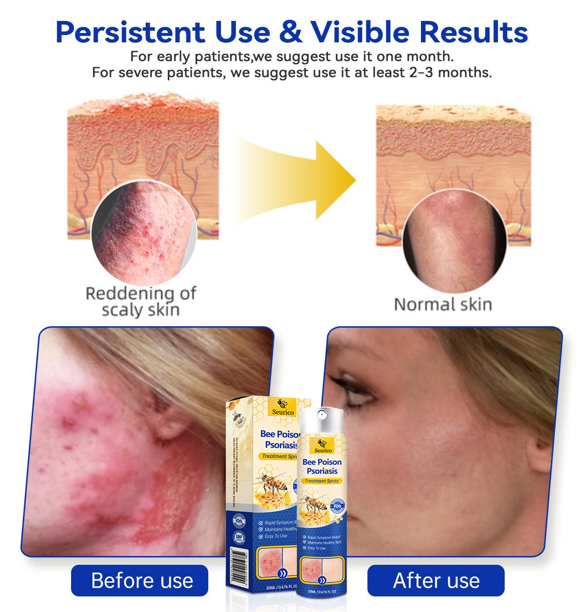 ✨【 official Brand Store】 Last Day Discount: 83% OFF 🌸 Seurico™ PsoriaHeal psoriasis Spray pro