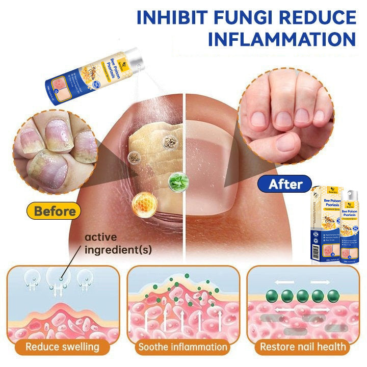 ✨【 official Brand Store】 Last Day Discount: 83% OFF 🌸 Seurico™ PsoriaHeal psoriasis Spray pro
