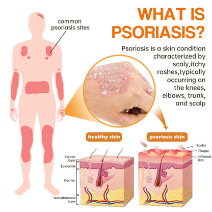 ✨【 official  Brand  Store】  Last Day Discount: 83% OFF 🌸 Seurico™ PsoriaHeal  psoriasis Spray pro