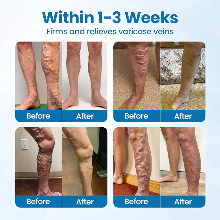 🎁Flash Sale - ODEIUN™ VeinGuard Herbal Spray-✅ Clinically proven to eliminate varicose veins in just 7 days!