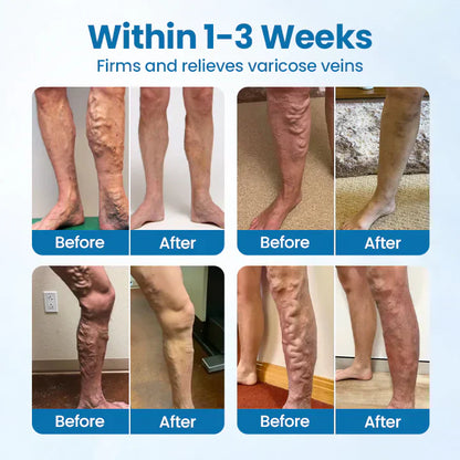 🎁Flash Sale - ODEIUN™ VeinGuard Herbal Spray-✅ Clinically proven to eliminate varicose veins in just 7 days!
