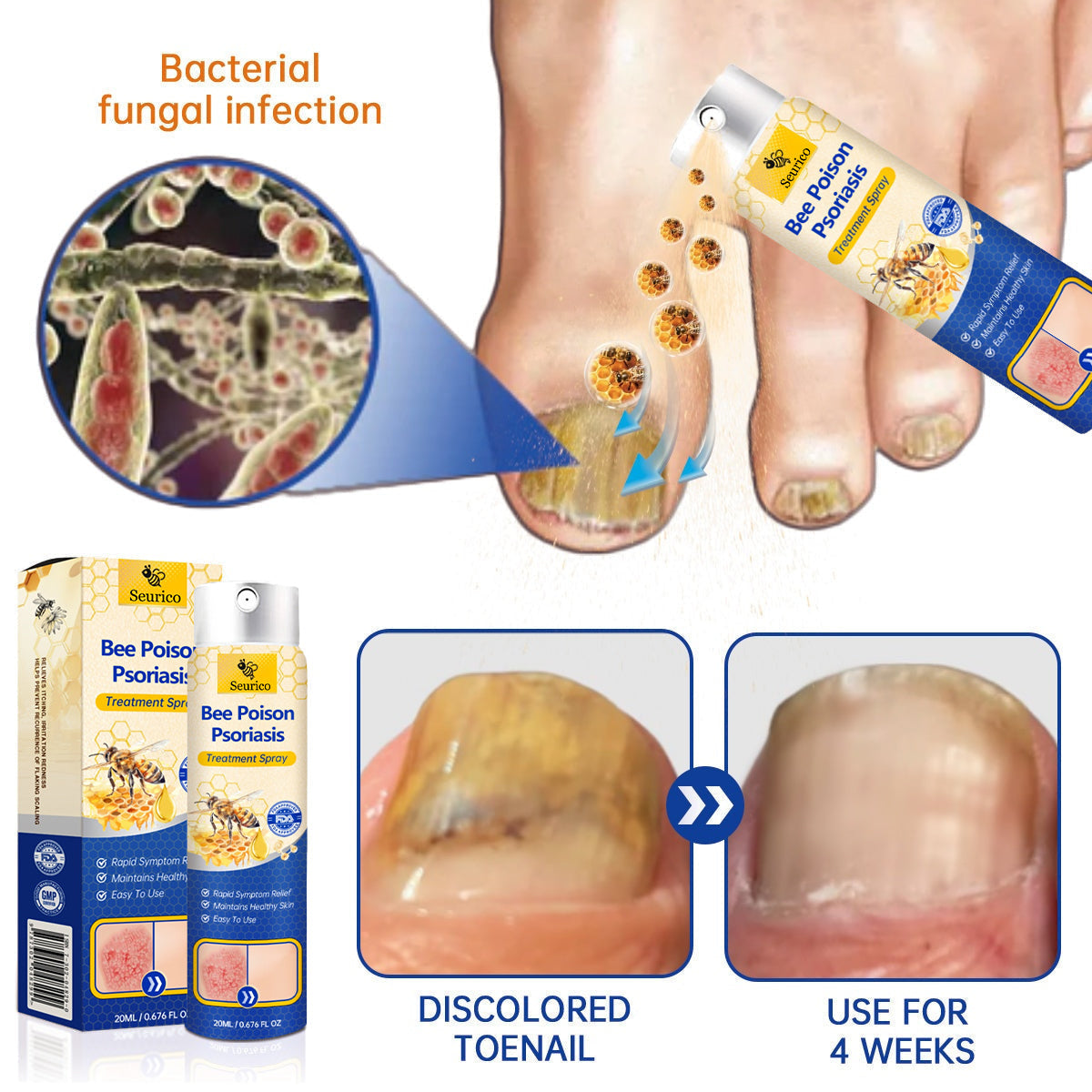 ✨【 official  Brand  Store】  Last Day Discount: 83% OFF 🌸 Seurico™ PsoriaHeal  psoriasis Spray pro