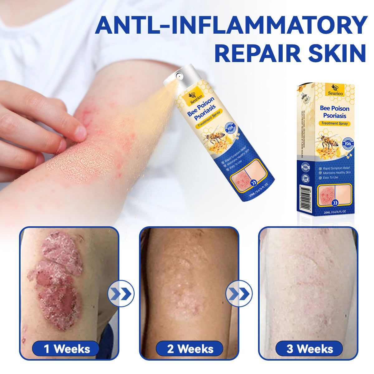 ✨【 official  Brand  Store】  Last Day Discount: 83% OFF 🌸 Seurico™ PsoriaHeal  psoriasis Spray pro