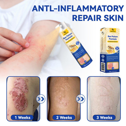 ✨【 official  Brand  Store】  Last Day Discount: 83% OFF 🌸 Seurico™ PsoriaHeal  psoriasis Spray pro