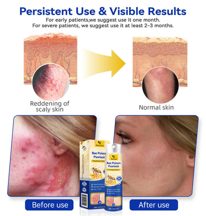 ✨【 official  Brand  Store】  Last Day Discount: 83% OFF 🌸 Seurico™ PsoriaHeal  psoriasis Spray pro