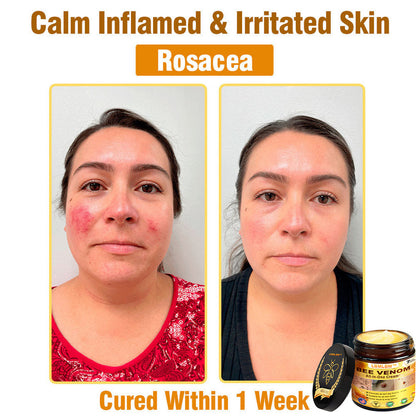 LBMLBM™ Bee Venom All-in-One Cream US Dermatologist Approved