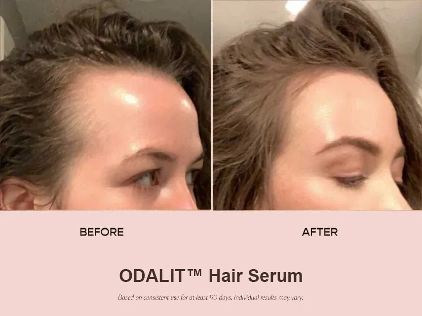 ODALIT™ Hair Serum - Clinically Proven HairRenewal for Men &Women 35+