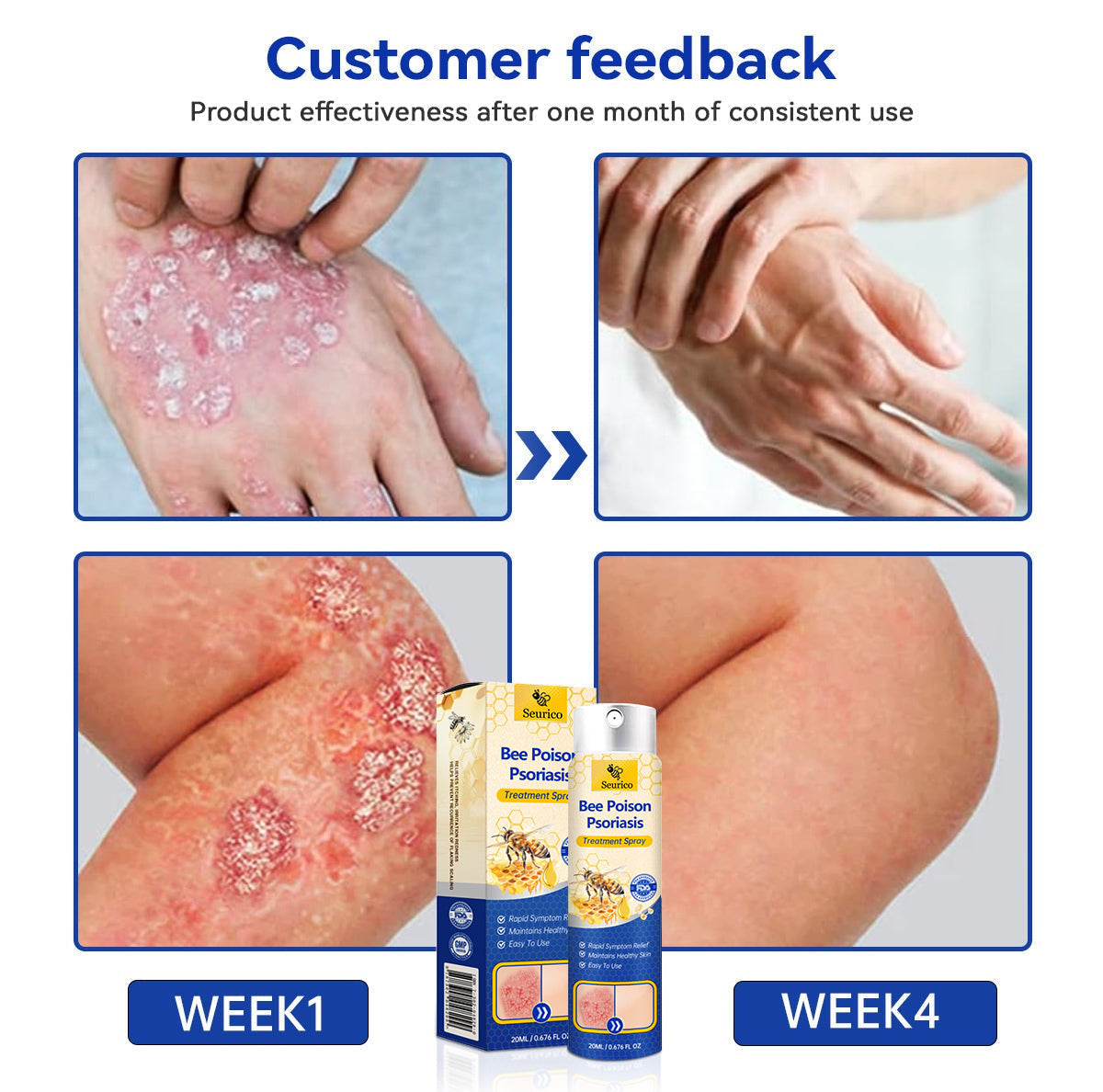 ✨【 official  Brand  Store】  Last Day Discount: 83% OFF 🌸 Seurico™ PsoriaHeal  psoriasis Spray pro